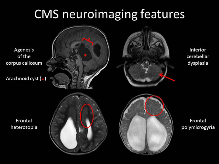 CMS neuroimaging features